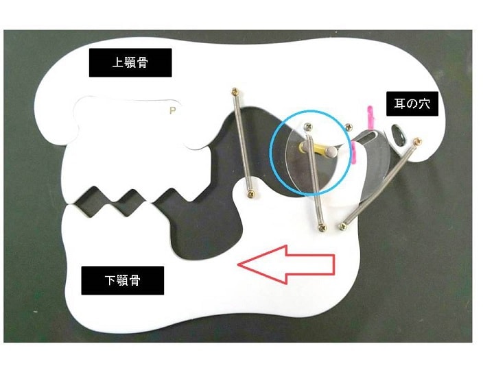 顎関節症の種類