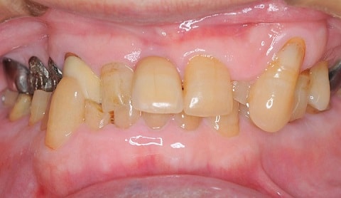 歯ぎしり型（グランディングタイプ）