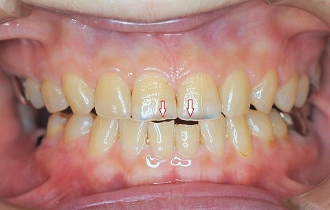 歯ぎしり型（グランディングタイプ）