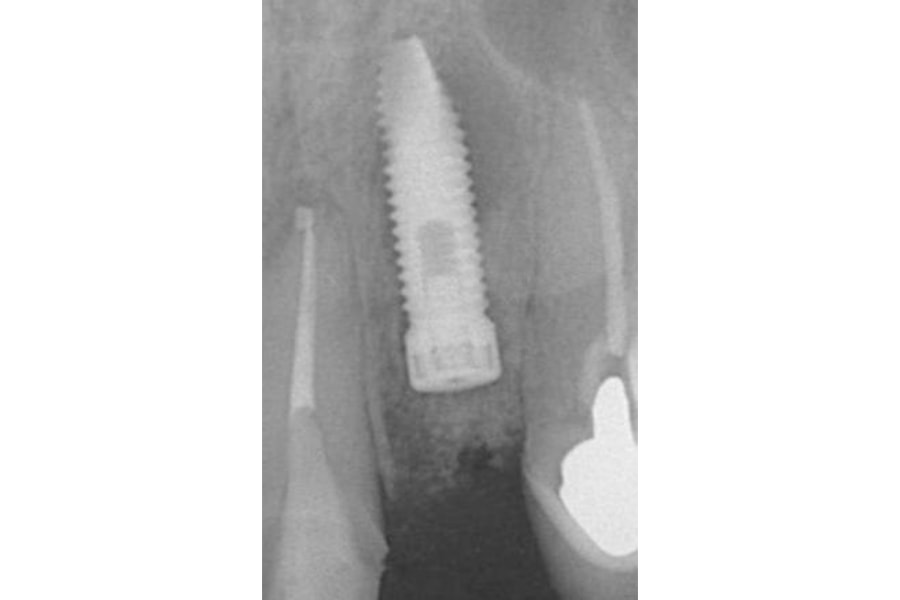 インプラント治療症例