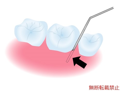 歯肉剥離搔爬術の流れ