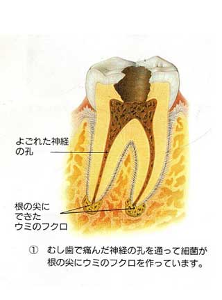 神経の治療の流れ