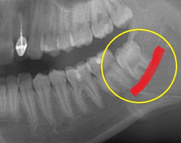 親知らず抜歯の症例