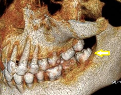 親知らず抜歯の症例